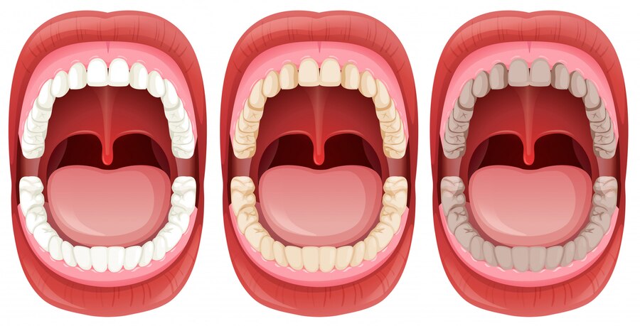 Tonsil